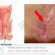 Bệnh nứt kẽ hậu môn là gì? Cách điều trị nứt kẽ hậu môn hiệu quả