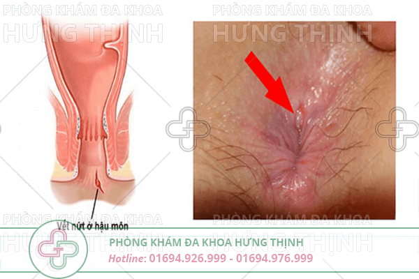 Bệnh nứt kẽ hậu môn là gì? Cách điều trị nứt kẽ hậu môn hiệu quả