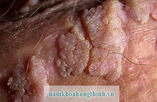Sùi mào gà bệnh xã hội nguy hiểm