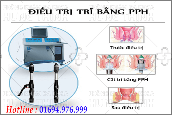 Bệnh trĩ nội độ 3 và trĩ nội độ 4 là gì ? Cách chữa bệnh hiệu quả