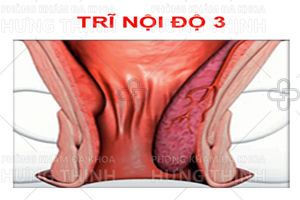 Bệnh trĩ nội độ 3 và trĩ nội độ 4 là gì ? Cách chữa bệnh hiệu quả