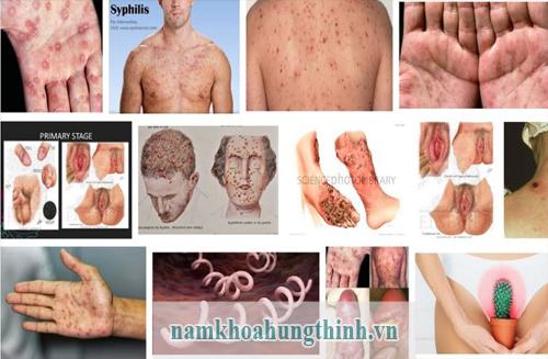 Giang mai bệnh xã hội nguy hiểm