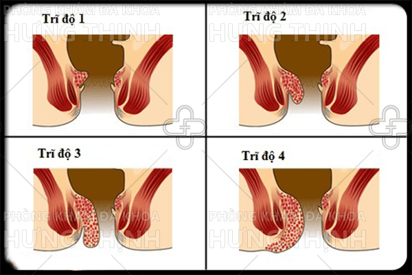 Cách chữa bệnh trĩ nội độ 1 hiệu quả