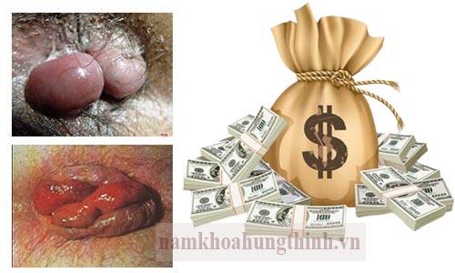 Chi phí điều trị bệnh trĩ