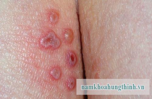 Mụn rộp sinh dục một trong số bệnh xã hội phổ biến