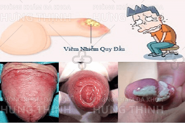 Tìm hiểu viêm bao quy đầu cấp tính và mãn tính