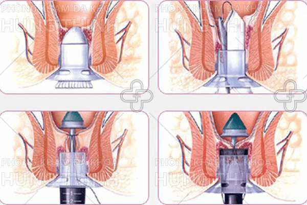 Trĩ hỗn hợp là gì? Cách điều trị trĩ hỗn hợp hiệu quả