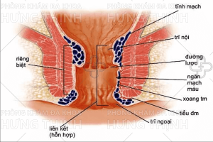 Trĩ hỗn hợp là gì? Cách điều trị trĩ hỗn hợp hiệu quả