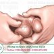 Đau tinh hoàn là gì ? Nguyên nhân, triệu chứng cách chữa đau tinh hoàn