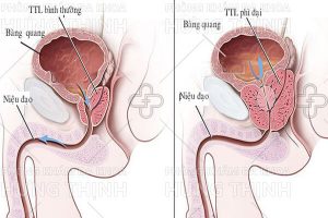 Phì đại tuyến tiền liệt là gì? Nguyên nhân, triệu chứng, cách chữa
