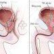 Phì đại tuyến tiền liệt là gì? Nguyên nhân, triệu chứng, cách chữa