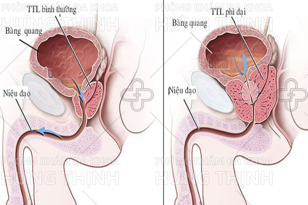 Phì đại tuyến tiền liệt là gì? Nguyên nhân, triệu chứng, cách chữa