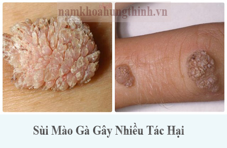 tác hại của sùi mào gà