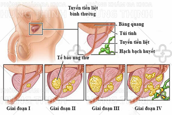 U xơ tiền liệt tuyến là gì ? Nguyên nhân, triệu chứng và cách chữa trị