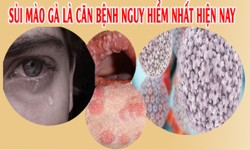 bệnh sùi mào gà