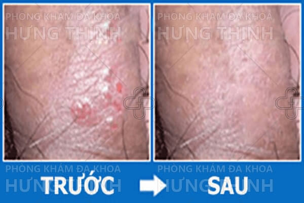 Bệnh Herpes sinh dục là bệnh gì? Nguyên nhân, triệu chứng, cách chữa