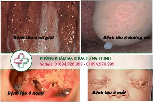 Bệnh lậu mãn tính - Nguyên nhân, triệu chứng, cách chữa