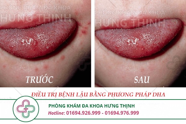 Bệnh lậu ở nữ giới - Nguyên nhân, dấu hiệu và cách điều trị
