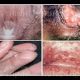 Bệnh lậu ở nữ giới - Nguyên nhân, dấu hiệu và cách điều trị