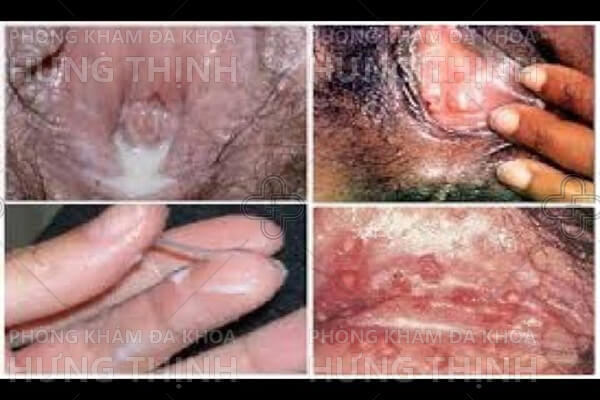Bệnh lậu ở nữ giới - Nguyên nhân, dấu hiệu và cách điều trị