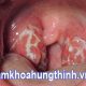 Hình ảnh bệnh lậu ở miệng