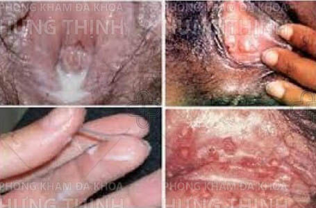 Hình ảnh bệnh lậu ở nữ giới