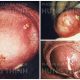 Nguyên nhân triệu chứng và cách điều trị bệnh lậu ở nam giới