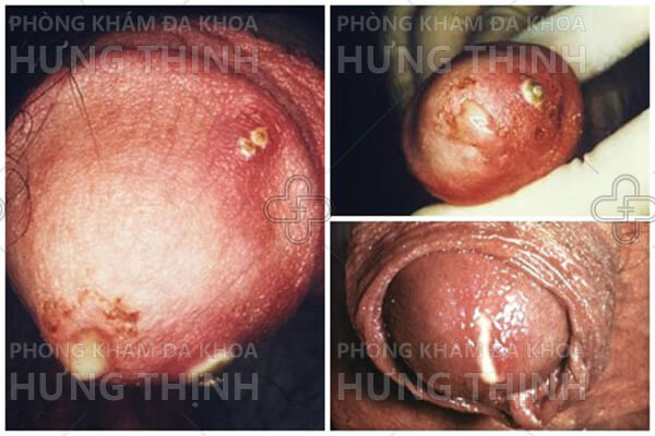 Nguyên nhân triệu chứng và cách điều trị bệnh lậu ở nam giới