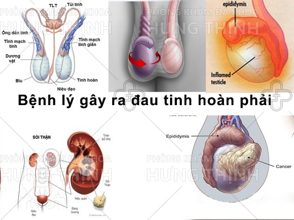 Đau tinh hoàn phải: Nguyên nhân, triệu chứng và cách chữa