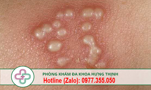 nổi mụn ở bộ phận sinh dục