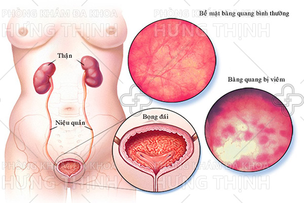 Viêm bàng quang cấp tính: Nguyên nhân, triệu chứng và cách điều trị