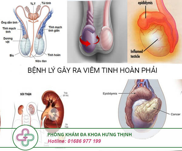 Viêm tinh hoàn phải - Nguyên nhân, triệu chứng, cách điều trị