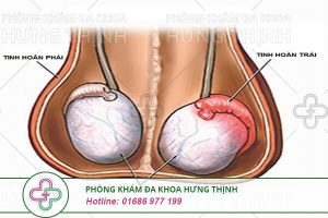 Viêm tinh hoàn trái: Triệu chứng, nguyên nhân và cách điều trị