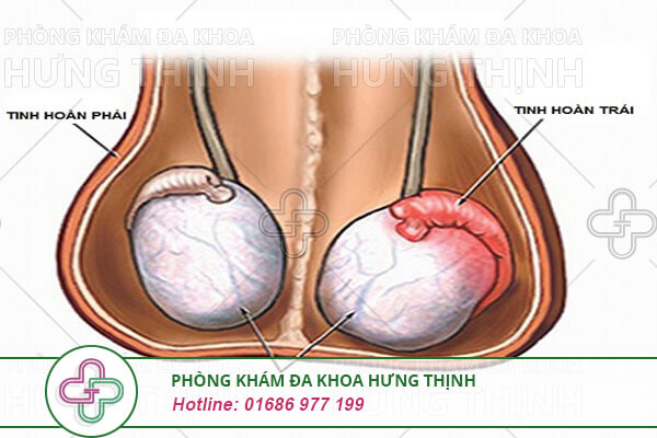 Viêm tinh hoàn trái: Triệu chứng, nguyên nhân và cách điều trị