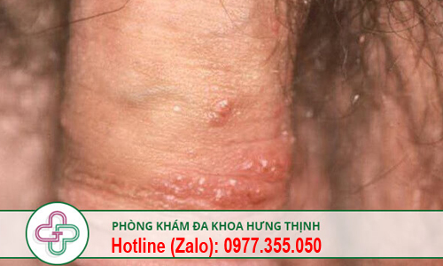 vùng kín nổi mụn là biểu hiện của bệnh gì
