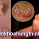 sùi mào gà lây qua những đường nào