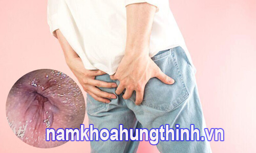 bệnh trĩ có lây không