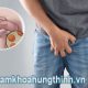 Sùi mào gà có gây ngứa không