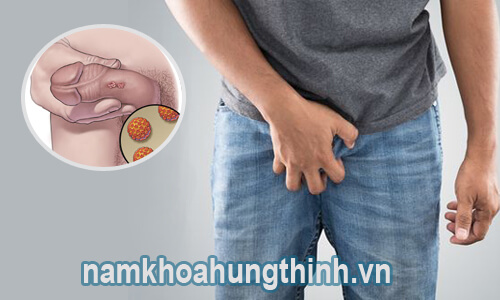 Sùi mào gà có gây ngứa không