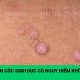 Mụn cóc sinh dục có nguy hiểm không