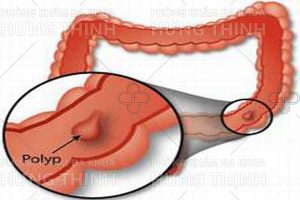 Bệnh polyp hậu môn là gì và sự nguy hiểm