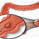 Bệnh polyp hậu môn là gì và sự nguy hiểm