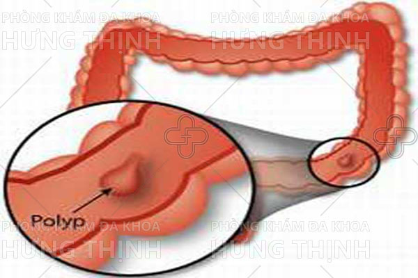 Bệnh polyp hậu môn là gì và sự nguy hiểm