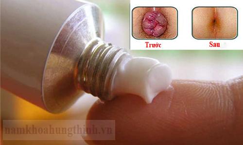 thuốc điều trị bệnh trĩ