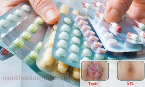 Thuốc chữa bệnh trĩ