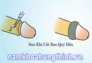 Sau khi cắt bao quy đầu bao lâu thì lành