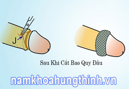 Sau khi cắt bao quy đầu bao lâu thì lành