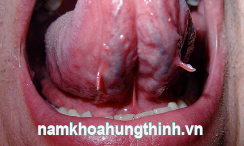 triệu chứng của sùi mào gà ở miệng