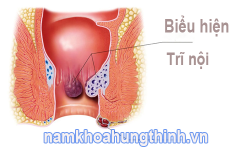 biểu hiện của trĩ nội