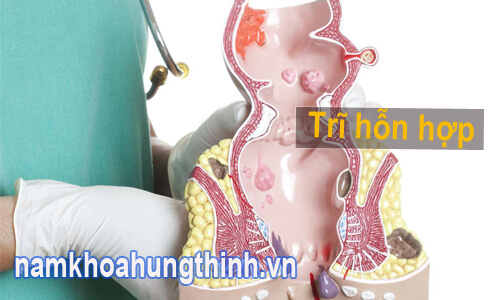 dấu hiệu của trĩ hỗn hợp